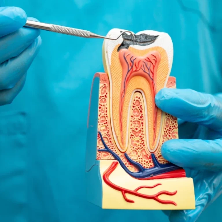 Root Canal Treatment