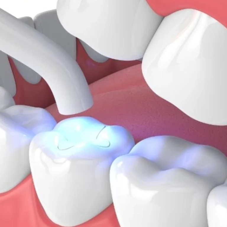 Tooth-Colored Fillings