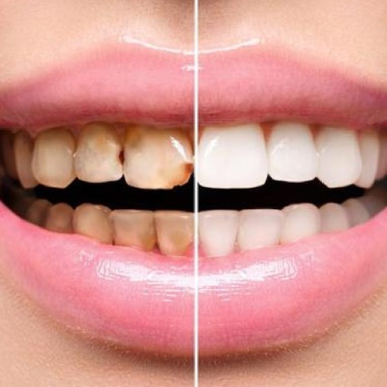 Veneers & Laminates
